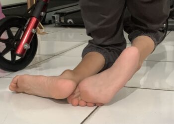 Anak berkebutuhan khusus yang mengidap cerebral palsy di Kota Medan. (Foto: narata/aan)