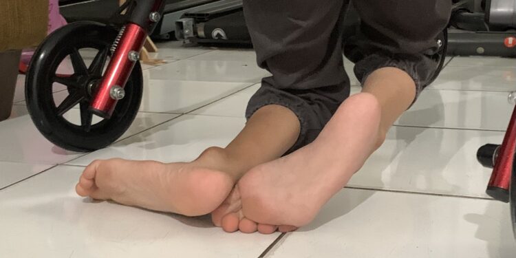 Anak berkebutuhan khusus yang mengidap cerebral palsy di Kota Medan. (Foto: narata/aan)